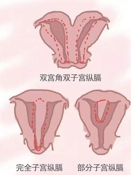 试管婴儿可以怀孕子宫畸形吗？子宫畸形生孩子有风险吗？